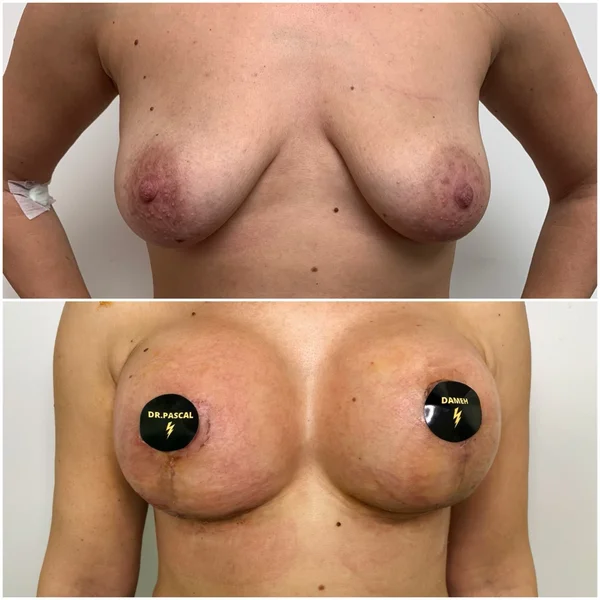 Mastopexie cu Implant - Rezultat 2