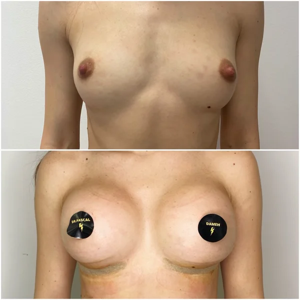 Augmentare Mamară - Implant - Rezultat 9