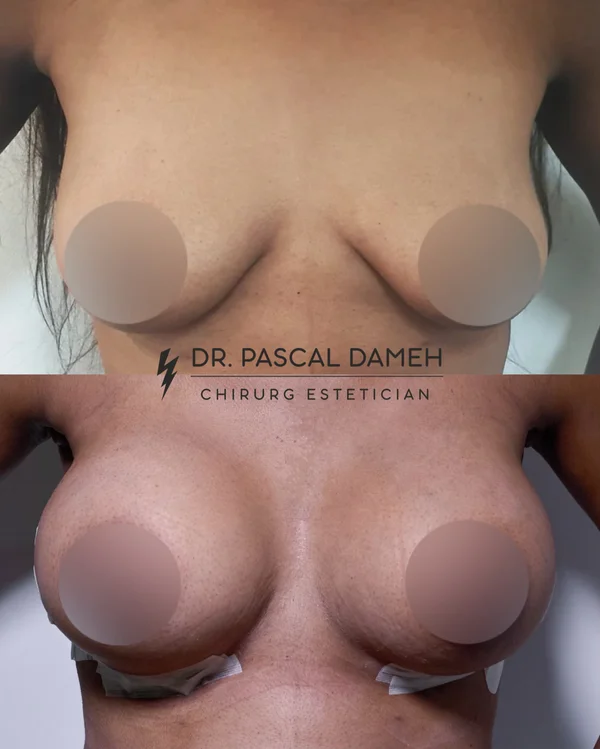 Augmentare Mamară - Implant - Rezultat 3
