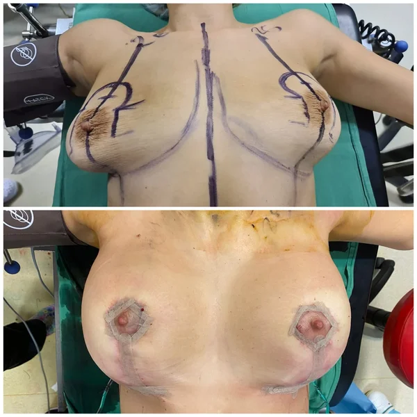 Mastopexie cu Implant - Rezultat 3