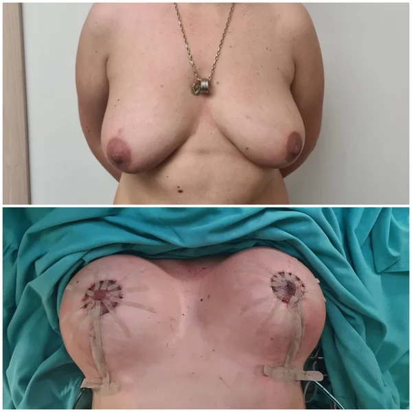 Mastopexie cu Implant - Rezultat 4