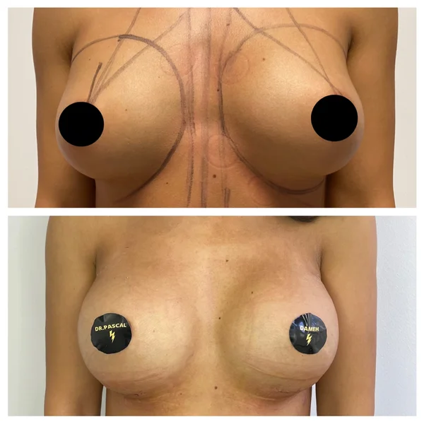 Augmentare Mamară - Implant - Rezultat 7