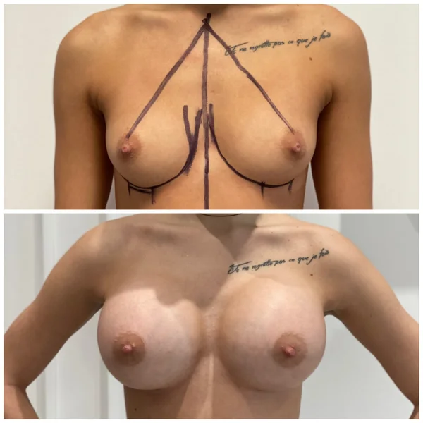 Augmentare Mamară - Implant - Rezultat 10