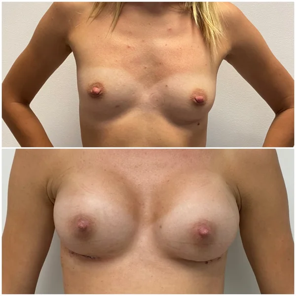 Augmentare Mamară - Implant - Rezultat 8