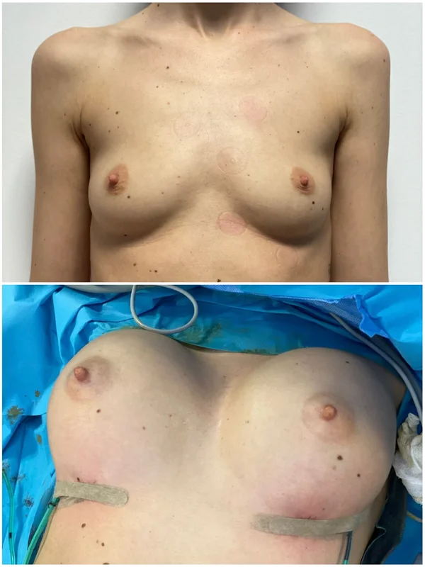 Augmentare Mamară - Implant - Rezultat 6